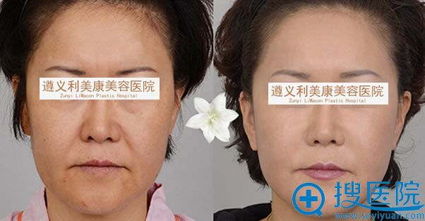 遵义利美康面部除皱案例 遵义利美康面部除皱案例
