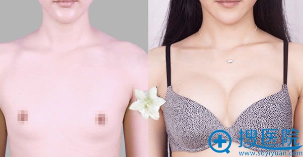 遵义利美康假体隆胸效果 遵义利美康假体隆胸效果