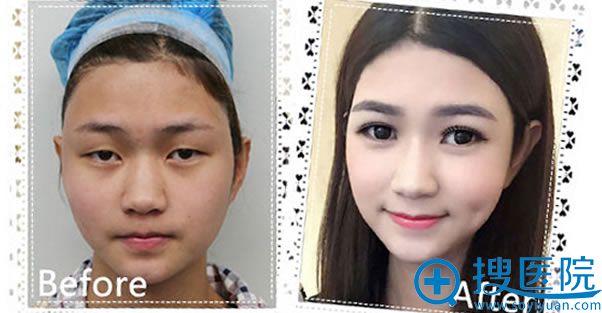 遵义利美康做双眼皮效果 遵义利美康做双眼皮效果