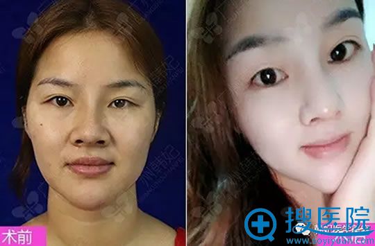 韩国<!--<i data=20240710 data-id=16794></i>-->鼻综合整形前后对比图 韩国<!--<i data=20240710 data-id=16794></i>-->鼻综合整形前后对比图
