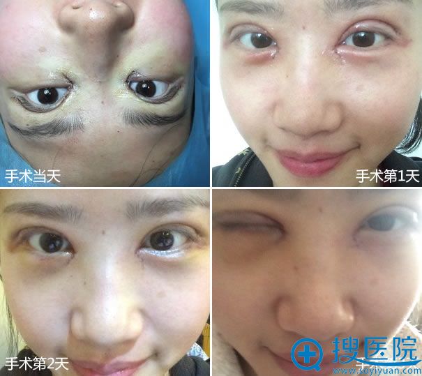 开内眼角手术前4天的恢复图片 开内眼角手术前4天的恢复图片