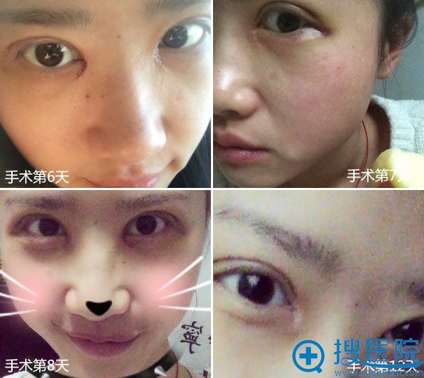 开眼角手术前10天恢复图 开眼角手术前10天恢复图