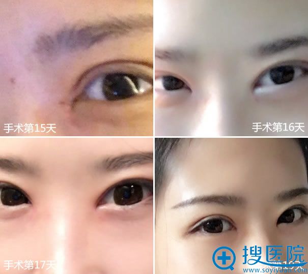 <!--<i data=20240710 data-id=11783></i>-->开眼角半个月的效果 <!--<i data=20240710 data-id=11783></i>-->开眼角半个月的效果