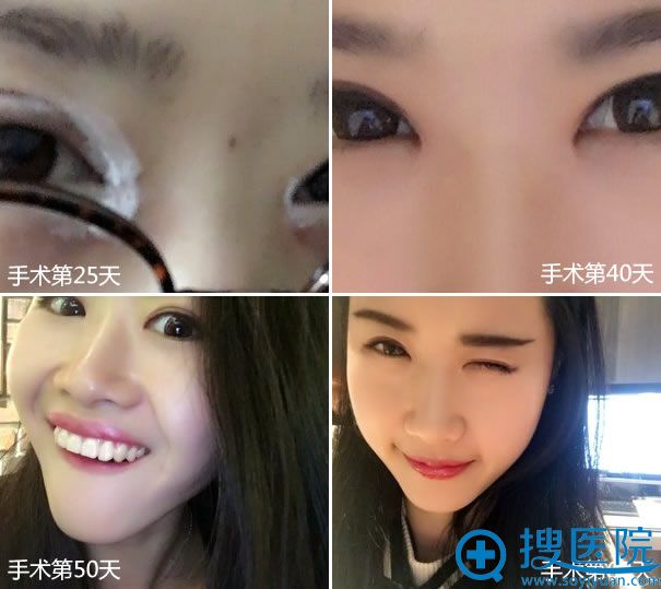 开眼角和双眼皮手术2个月效果 开眼角和双眼皮手术2个月效果