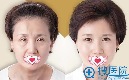 蔡光浩面部除皱案例 蔡光浩面部除皱案例