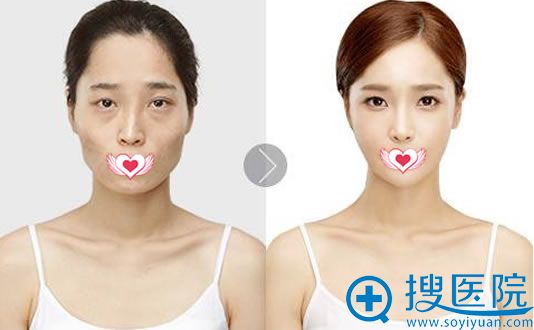 蔡光浩360度面部立体精雕案例 蔡光浩360度面部立体精雕案例