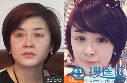 沈阳美联致美V-Lifting 紧致瘦脸术案例对比图 沈阳美联致美V-Lifting 紧致瘦脸术案例对比图
