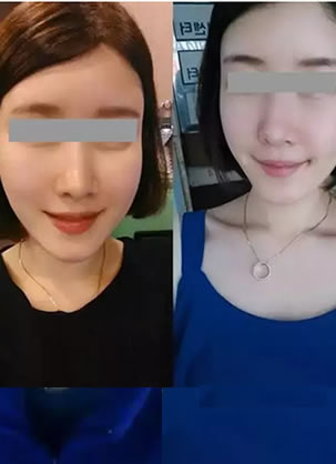 变美秘籍:广州华美自体脂肪面部填充3个月后从大妈变为女神