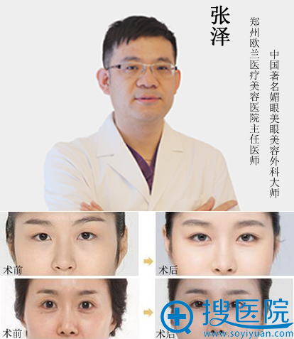 <!--<i data=20240710 data-id=12280></i>-->张泽眼部整形案例 <!--<i data=20240710 data-id=12280></i>-->张泽眼部整形案例