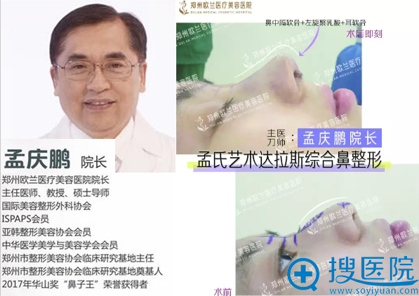 <!--<i data=20240710 data-id=12280></i>-->孟庆鹏孟氏达拉斯综合鼻整形案例 <!--<i data=20240710 data-id=12280></i>-->孟庆鹏孟氏达拉斯综合鼻整形案例
