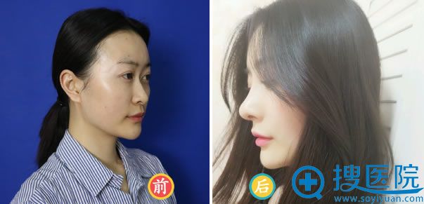 成都美极做鼻综合的效果怎么样 成都美极做鼻综合的效果怎么样
