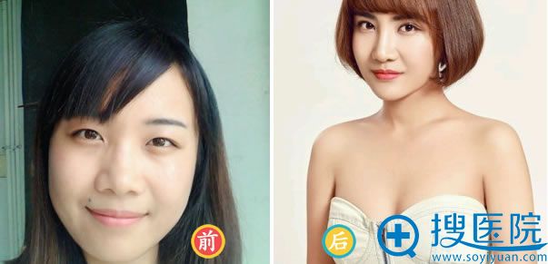 成都美极双眼皮案例效果 成都美极双眼皮案例效果