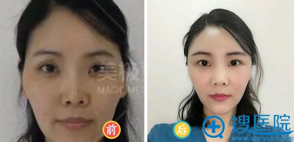 成都美极整形自体脂肪填充额头效果 成都美极整形自体脂肪填充额头效果