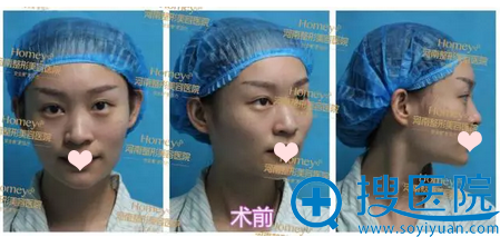 鼻子很塌没鼻梁怎么办 河南整形医院隆鼻综合手术7天还你小翘鼻