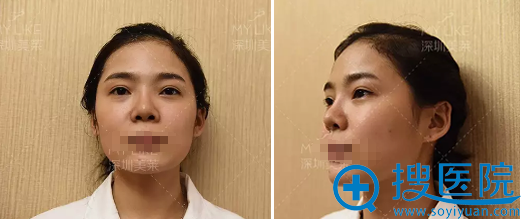 深圳美莱梁晓健鼻修复术前照片 深圳美莱梁晓健鼻修复术前照片