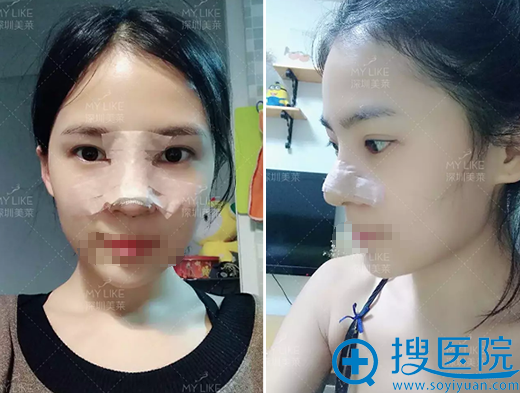 深圳美莱梁晓健鼻修复术后恢复期照片 深圳美莱梁晓健鼻修复术后恢复期照片