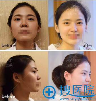 深圳美莱梁晓健鼻修复手术前后对比图 深圳美莱梁晓健鼻修复手术前后对比图