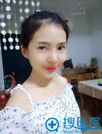 深圳美莱梁晓健鼻修复术后效果照片 深圳美莱梁晓健鼻修复术后效果照片