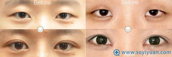 双眼皮前后案例图_长沙艺星美容医院 双眼皮前后案例图_长沙艺星美容医院