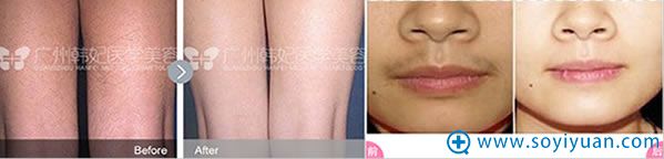 广州韩妃脱毛前后对比案例 广州韩妃脱毛前后对比案例
