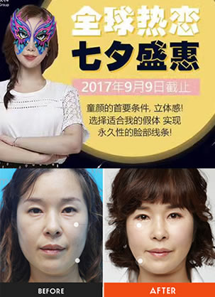 韩国那木整形医院七夕优惠活动 贵族手术or童颜手术7700元