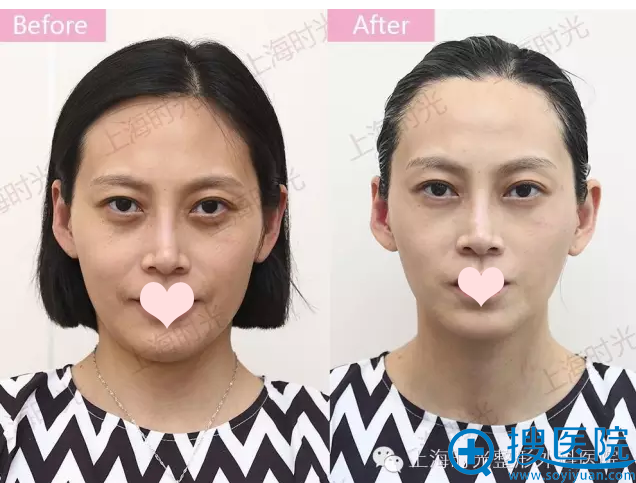第四代黄金热玛吉治疗效果对比图 第四代黄金热玛吉治疗效果对比图