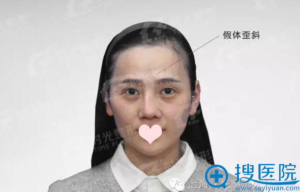 上海时光医院许黎平隆鼻失败修复案例 一起来看术后效果怎么样