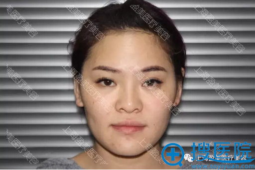 上海盈美杨璐医生怎么样?帮助隆鼻失败修复两次的她重获新生