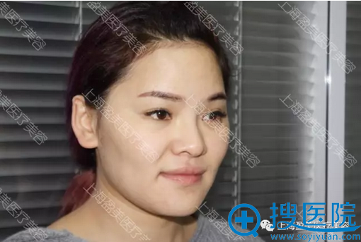 鼻部侧面照 鼻部侧面照