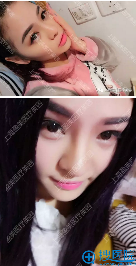 隆鼻失败修复术后一个月 隆鼻失败修复术后一个月
