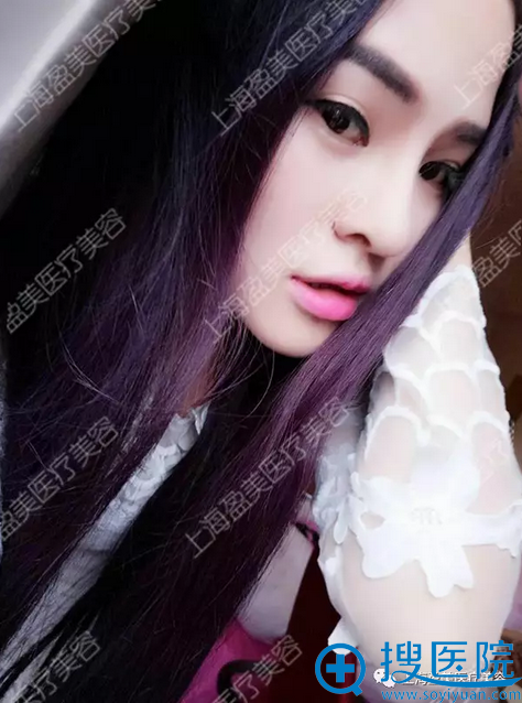 隆鼻失败修复一个月生活照 隆鼻失败修复一个月生活照