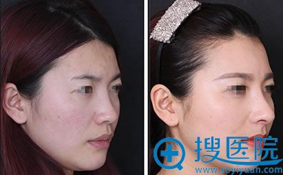 假体隆鼻前后对比案例_<!--<i data=20240710 data-id=8320></i>-->美容医院 假体隆鼻前后对比案例_<!--<i data=20240710 data-id=8320></i>-->美容医院