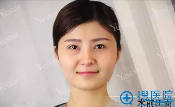 在武汉艺星整形医院做皇室绢丝术前照 在武汉艺星整形医院做皇室绢丝术前照