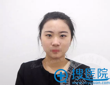 杭州瑞丽宋建良做鼻子好吗 鼻综合术后真实对比照片告诉你真相