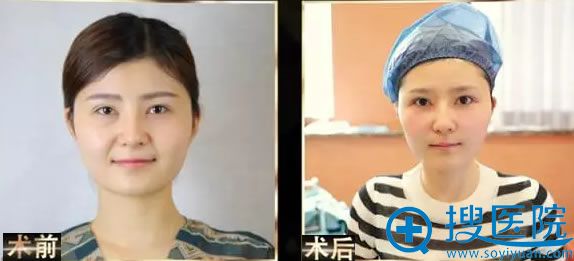 武汉艺星整形皇室绢丝面部提升案例 武汉艺星整形皇室绢丝面部提升案例