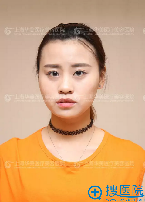 上海华美鼻综合做的怎么样 李健隆鼻+假体垫下巴案例见证实力