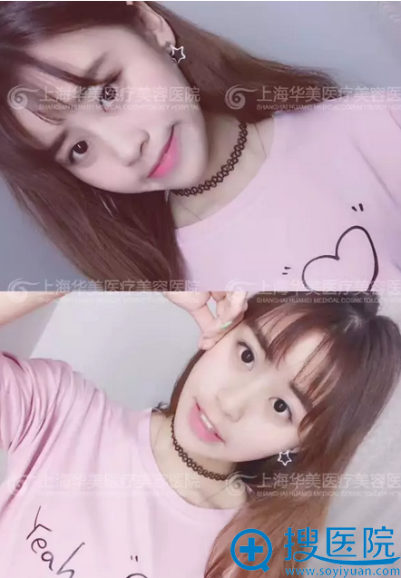 鼻综合第八天拆完线 鼻综合第八天拆完线