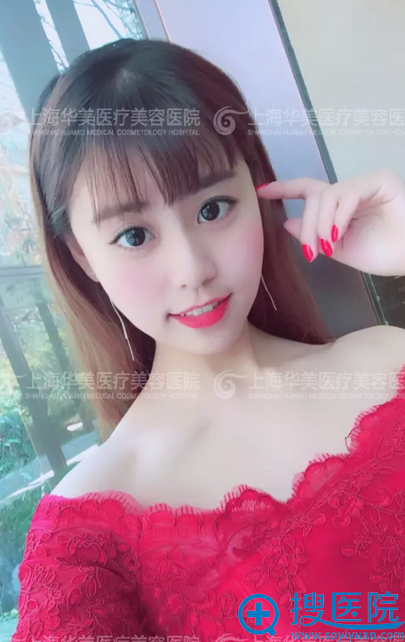 鼻综合+垫下巴术后20天的样子 鼻综合+垫下巴术后20天的样子
