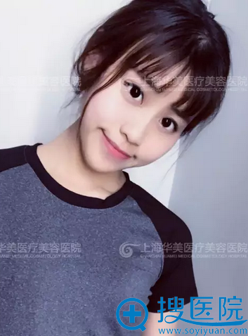 找李健院长做完鼻综合1个月了 找李健院长做完鼻综合1个月了