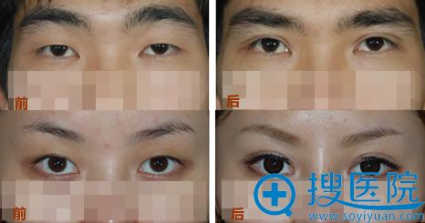 无痕双眼皮前后对比案例_郑州一美美容医院 无痕双眼皮前后对比案例_郑州一美美容医院