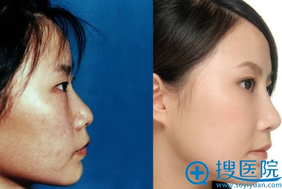 鼻综合前后对比效果_河南郑州一美整形 鼻综合前后对比效果_河南郑州一美整形