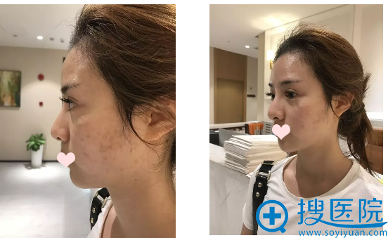上海薇琳医美顾陆健院长鼻综合案例 7天妹子从路人秒变女神