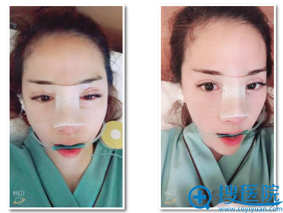 上海薇琳顾陆健院长鼻综合术后天 上海薇琳顾陆健院长鼻综合术后天