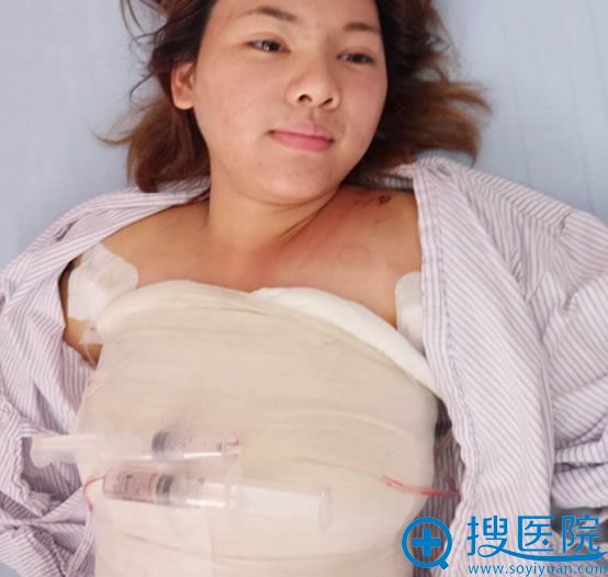 <!--<i data=20240710 data-id=8320></i>-->假体隆胸术后3天照片 <!--<i data=20240710 data-id=8320></i>-->假体隆胸术后3天照片