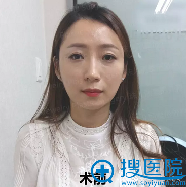 韩国珠儿丽面部脂肪填充+双下巴吸脂术前照 韩国珠儿丽面部脂肪填充+双下巴吸脂术前照