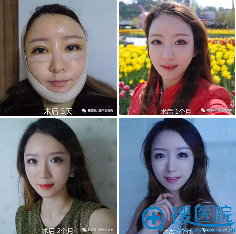 眼综合+面部脂肪填充+双下巴吸脂恢复过程 眼综合+面部脂肪填充+双下巴吸脂恢复过程