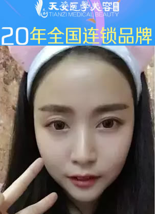 广州天姿整形自体脂肪面部填充 从大方脸变小V脸蜕变过程