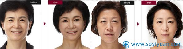 除皱提升对比效果_赣州韩美整形 除皱提升对比效果_赣州韩美整形