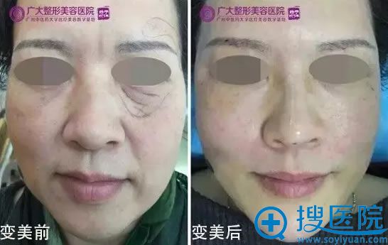 6D面部线雕术即刻效果对比 6D面部线雕术即刻效果对比