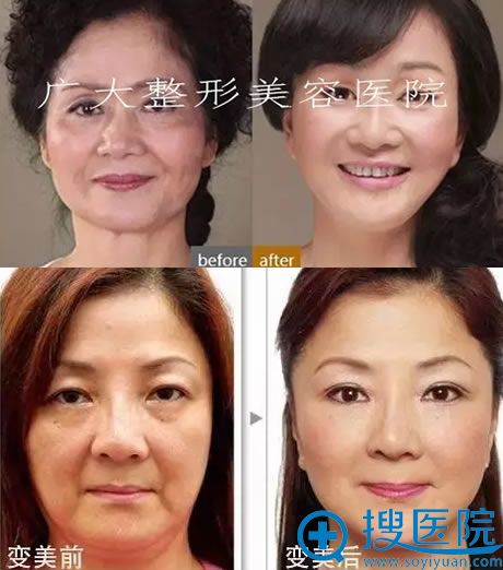 广州广大整形面部线雕提升前后对比案例 广州广大整形面部线雕提升前后对比案例